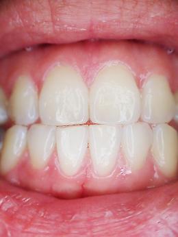 Alfabeto di Sbadanza: D come Dente